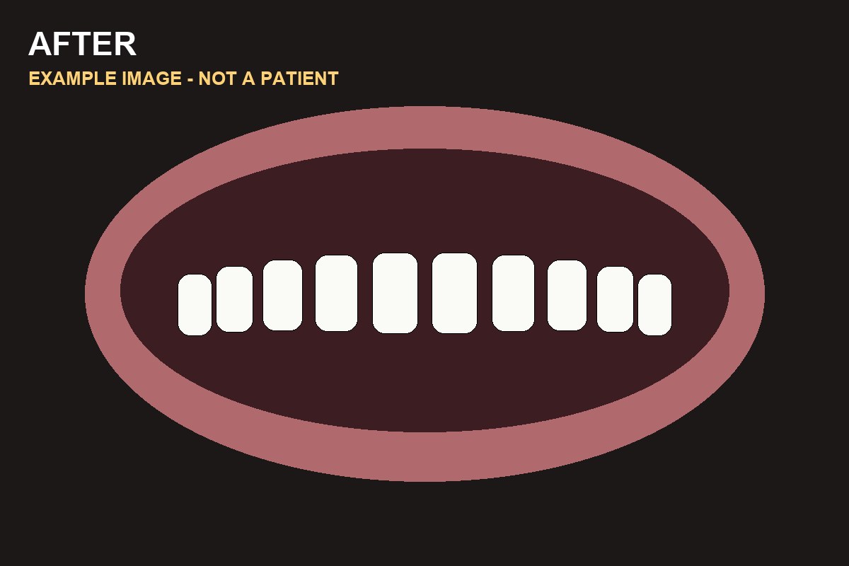 Example illustration of teeth after whitening